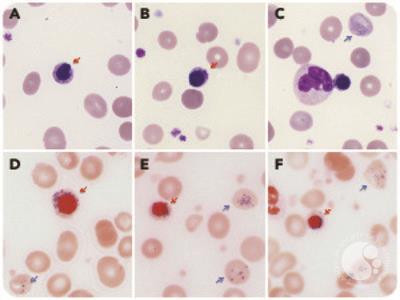 Transient appearance of ring sideroblasts in peripheral blood in the acute phase of secondary hemolytic anemia