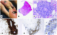 Severe mosquito bite allergy: an unusual EBV NK cell lymphoproliferative disorder