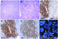 “Double-hit” follicular lymphoma