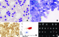 T-cell prolymphocytic leukemia presenting as ascites