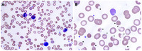 Oxidative hemolysis due to Wilson disease