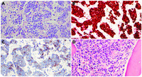 Li-Fraumeni syndrome presenting as precursor B lymphoblastic leukemia mimicking intravascular large B-cell lymphoma