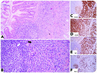 B-lymphoblastic leukemia/lymphoma with an unusual appendiceal involvement