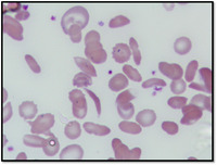 Case history of a child with sickle cell anemia in India