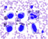 Lymphocytes in Sanfilippo syndrome display characteristic Alder-Reilly anomaly