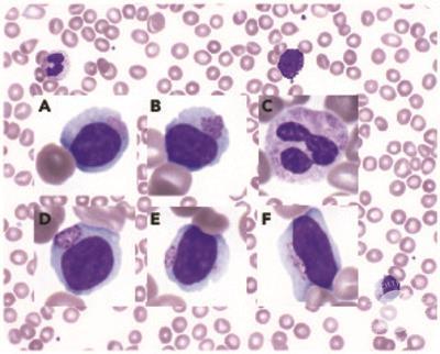Lymphocytes in Sanfilippo syndrome display characteristic Alder-Reilly anomaly