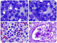 Simultaneous acute myeloid leukemia, multiple myeloma, and amyloidosis