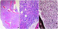 Autoimmune panmyelosis with myelofibrosis