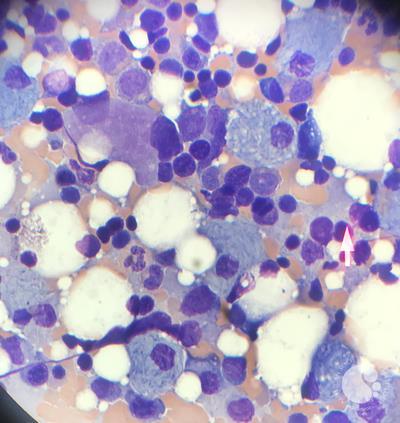 Pseudo-Gaucher cells