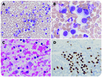 A rare case of circulating melanoma cells in peripheral blood