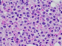 Core Biopsy, Plasmacytoid Cells