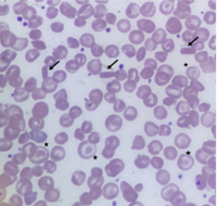 hemoglobin sc disease blood smear