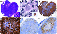 Hiding in the mantle: mantle cell lymphoma with a mantle zone growth pattern co-occurring with CMV lymphadenitis