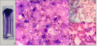 A matter of staining? Bone marrow necrosis in young male patient