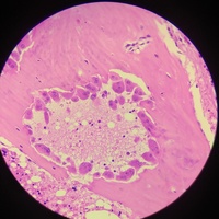 RENAL OSTEODYSTROPHY 2