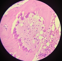 RENAL OSTEODYSTROPHY 4