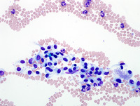 Normal endothelial cells in blood smears.