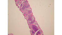 Myeloma-Bone marrow trephine