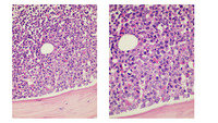 Myeloma-Marrow core biopsy H&E