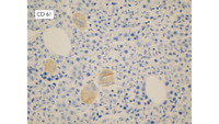 Myeloma-CD61 immunostain