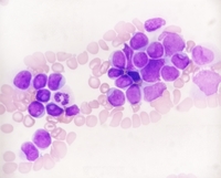 Cup shaped blasts in AML with mutated NPM1 and FLT3