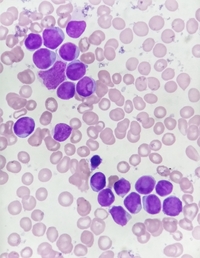 Cup shaped blasts in AML with mutated NPM1 and FLT3