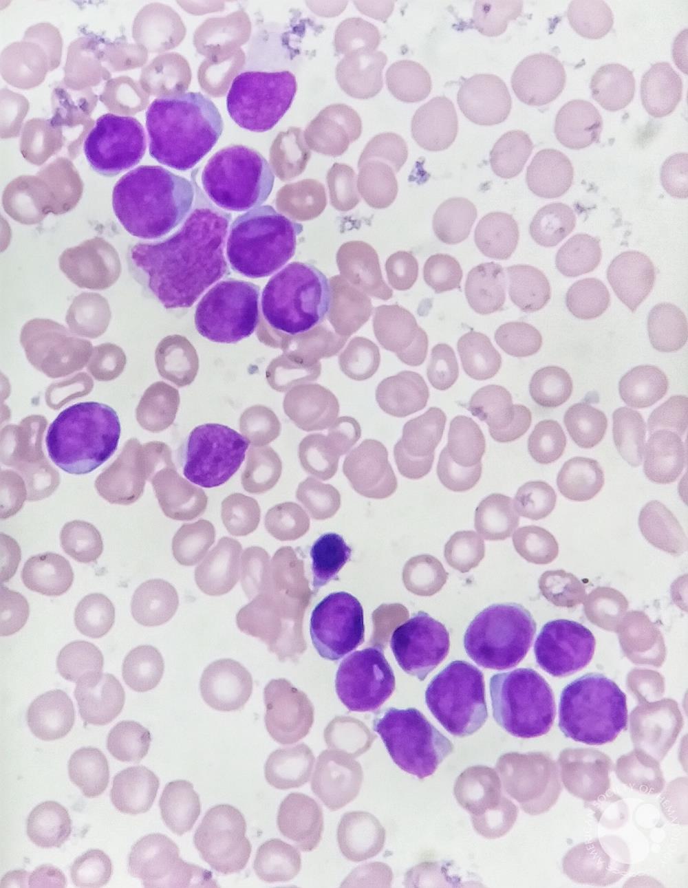 Cup shaped blasts in AML with mutated NPM1 and FLT3