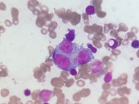 endomitosis in malignant plasma cell