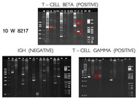 Indolent T-cell Lymphoproliferative Disorder: TCR Gamma & TCR Beta