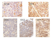 Indolent T-cell Lymphoproliferative Disorder: CD20, CD3, CD5, CD2, & CD7