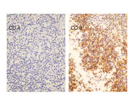 Indolent T-cell Lymphoproliferative Disorder: CD4 & CD8