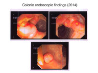 Indolent T-cell Lymphoproliferative Disorder: Colonoscopy