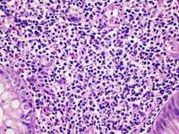 Indolent T-cell Lymphoproliferative Disorder: H&E High Power