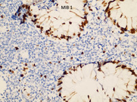 Indolent T-cell Lymphoproliferative Disorder: MB1