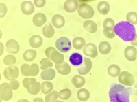 Howell Jolly bodies