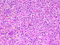 Warthin-Finkeldey-like cells in Hodgkin lymphoma