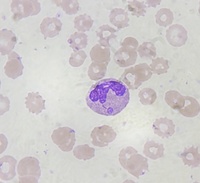 Neutrophil - Bulbous Nuclear Appendage