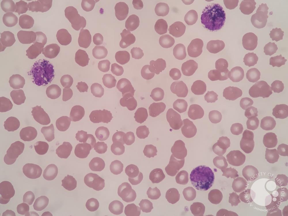 Pigment in neutrophils and myeloid cells 1