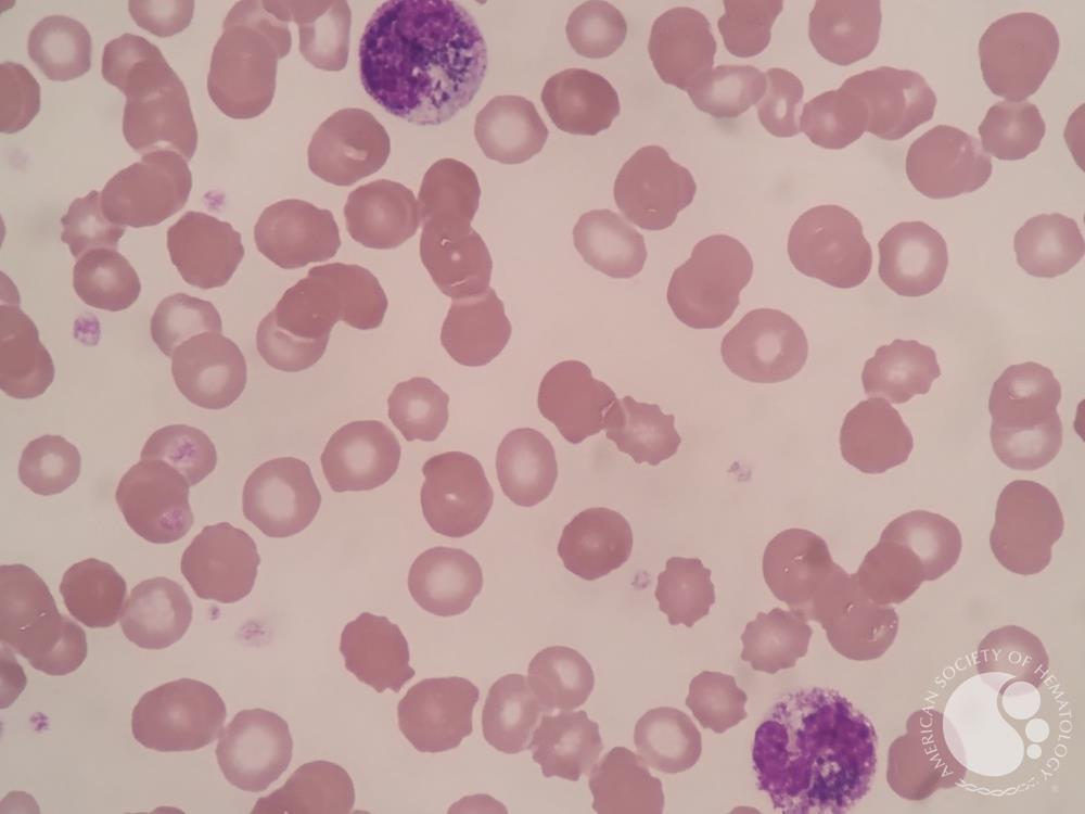 Pigment in neutrophils and myeloid cells 2