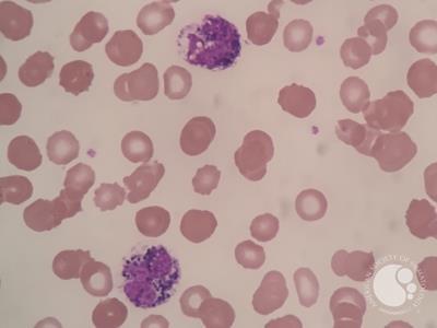 Pigment in neutrophils and myeloid cells 3