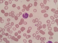 Pigment in neutrophils and myeloid cells 5