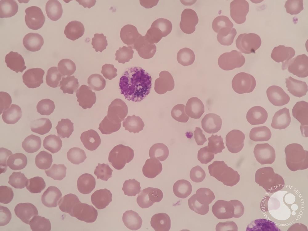 Pigment in neutrophils and myeloid cells 5