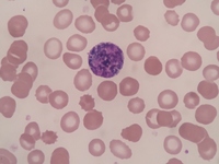 Pigment in neutrophils and myeloid cells 6