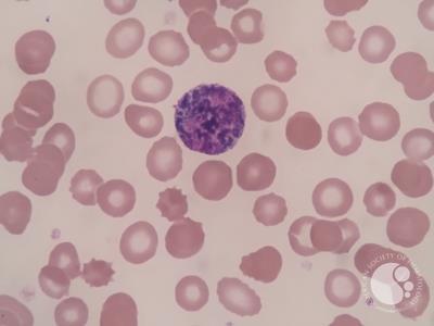 Pigment in neutrophils and myeloid cells 6