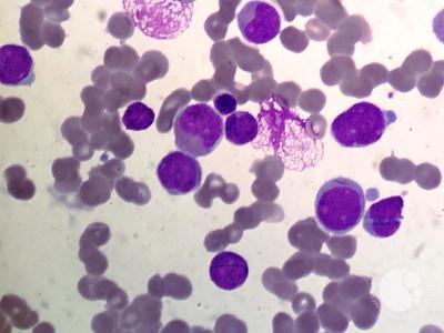 Myeloblast in AML with t(8;21) 1