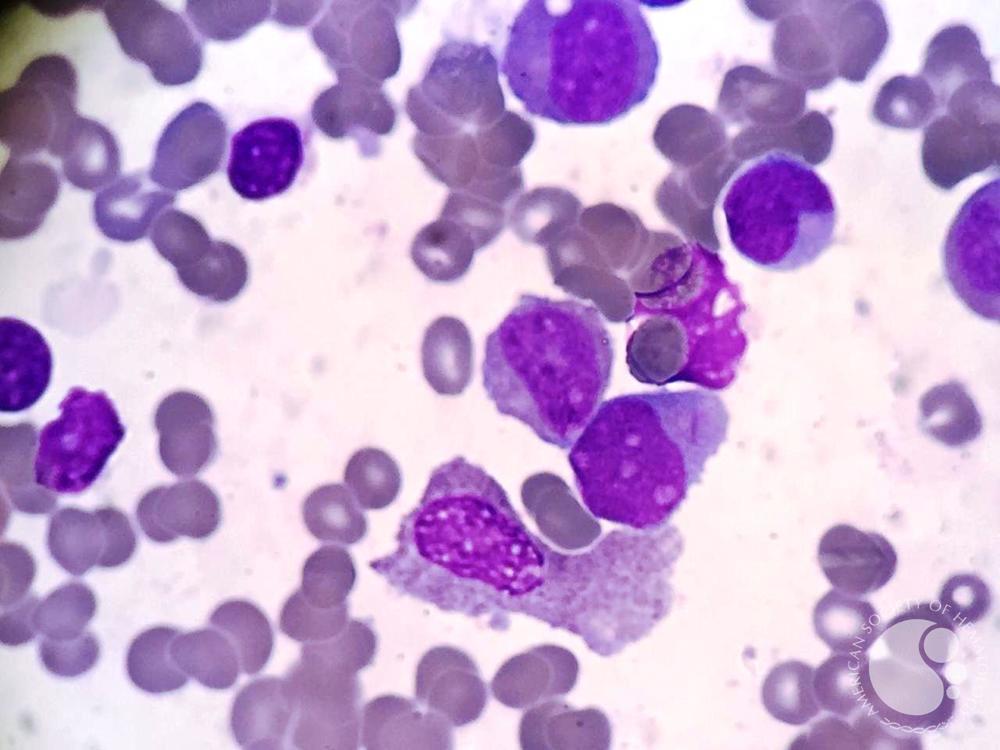 Myeloblast in AML with t(8;21) 2