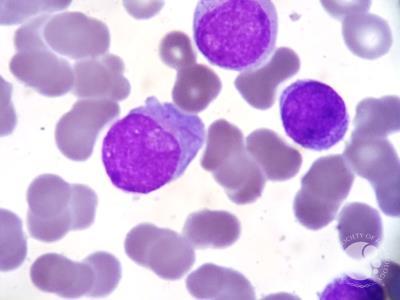 Myeloblasts with AML with t(8;21)