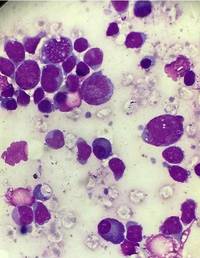 T-Acute Lymphoblastic Leukemia with Plasmacytosis 2