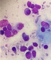 T-Acute Lymphoblastic Leukemia with Plasmacytosis 3