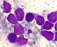 T-Acute Lymphoblastic Leukemia with Plasmacytosis 4